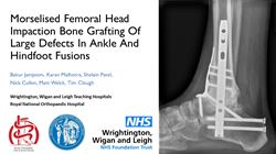 Impaction bone grafting of large defects in ankle and hindfoot fusions