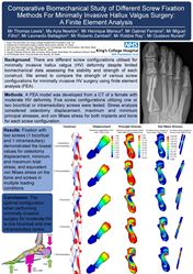 Comparative Biomechanical Study of Different Screw Fixation Methods For Minimally Invasive Hallux Valgus Surgery: A Finite Element Analysis
