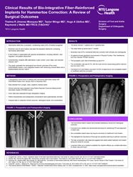 Clinical Results of Bio-Integrative Fiber-Reinforced Implants for Hammertoe Correction: A Review of Surgical Outcomes