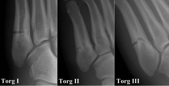 BOFAS > Hyperbook > Trauma > Stress Fractures