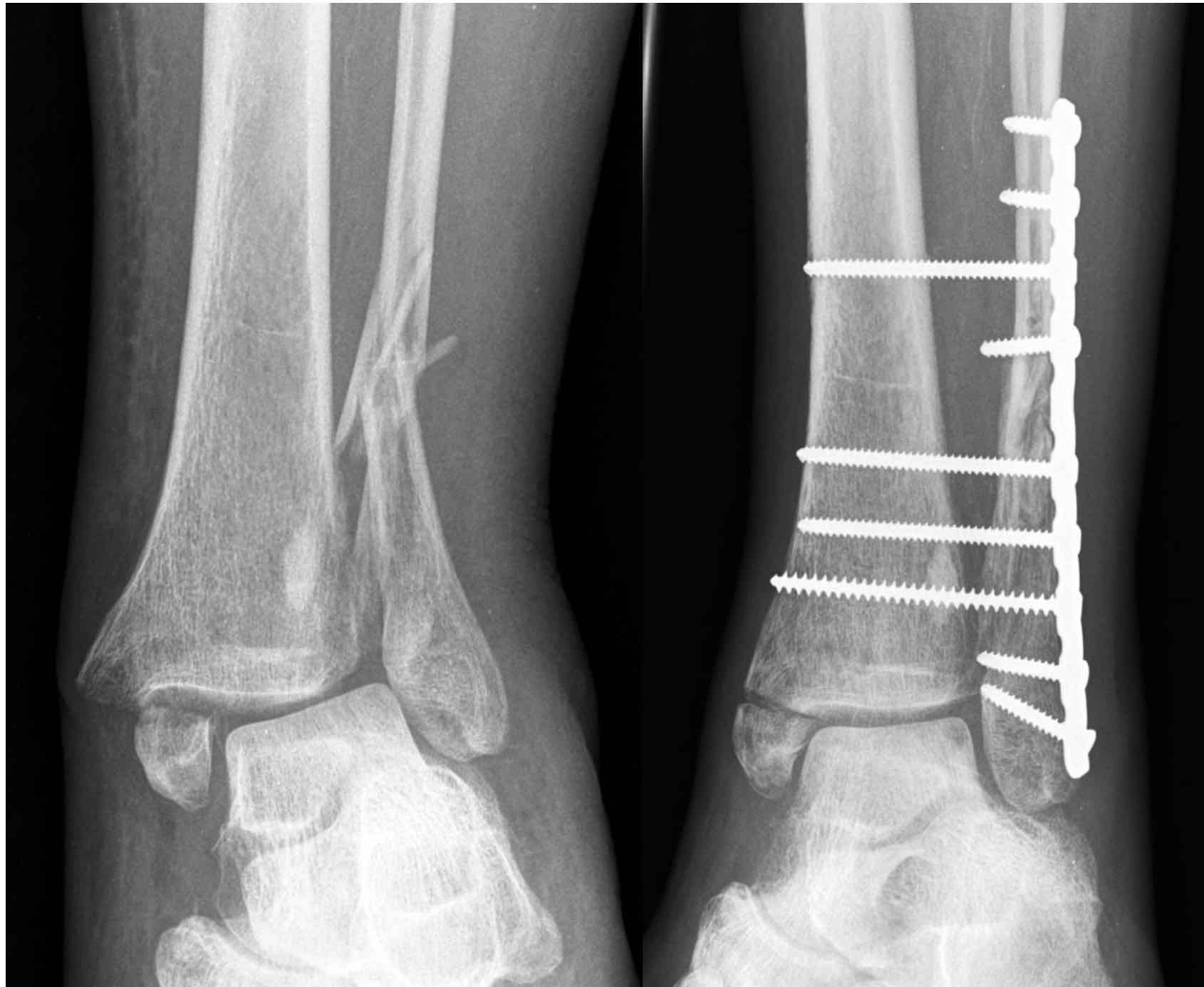 Left Tibia Fixation BOFAS > Hyperbook > Trauma > Ankle Fractures > Diabetic Ankle Fractures
