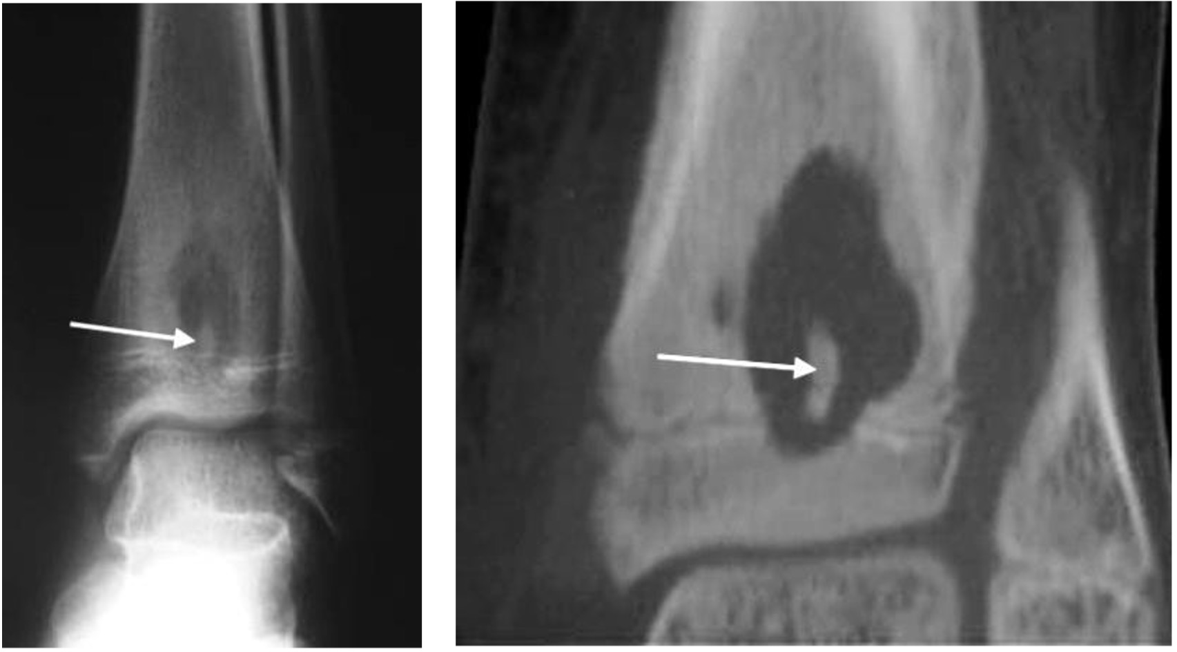 Tibia Abscess BOFAS > Hyperbook > Radiology > 4. Bone Pathology