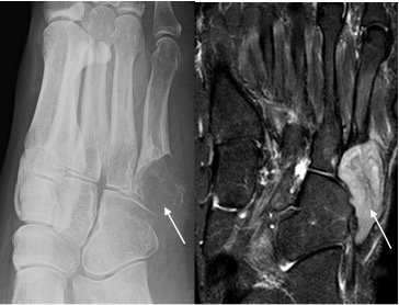 BOFAS > Hyperbook > Radiology > 6. Bone Tumours