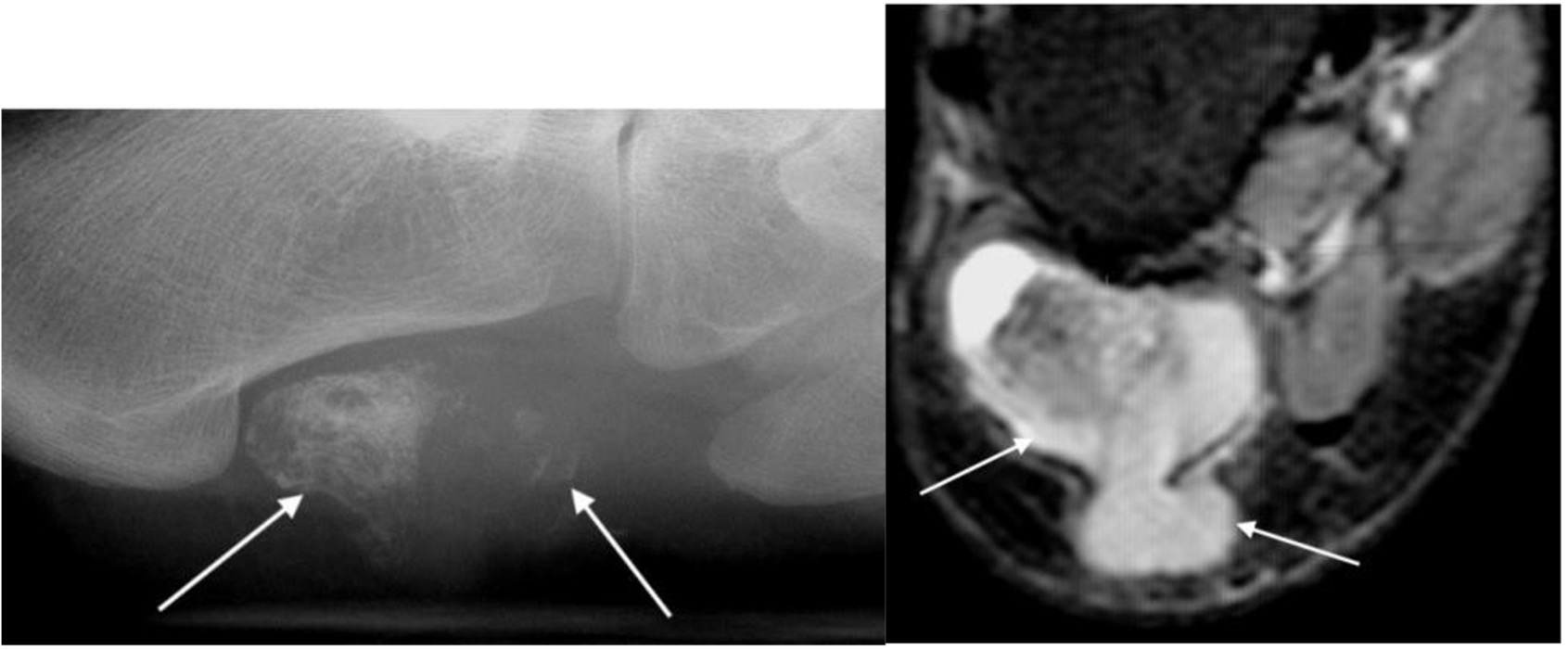 BOFAS > Hyperbook > Radiology > 8. Joint and Soft Tissue Pathology