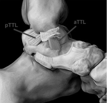BOFAS > Hyperbook > Trauma > Deltoid Ligament Injury